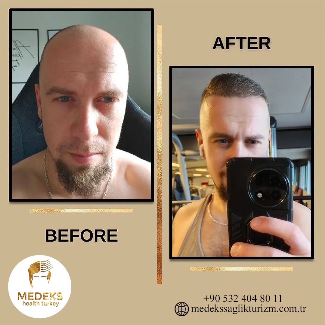 Before & After 4